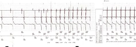 Early Complications After Pacemaker Implantations Intechopen