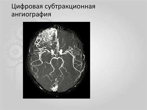 Ангиография в неврологии - презентация онлайн