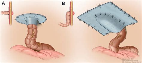 Mesh Reinforcement Of Parastomal Hernia Defects A Keyhole