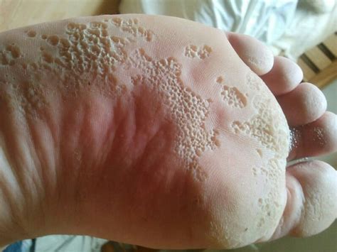 133 Best R Trypophobia Images On Pholder My Leg After A Shower