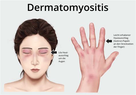 Dermatomyositis Ursachen Symptome Behandlung