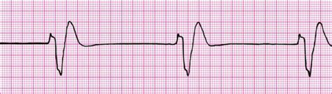 idioventricular-rhythm - Cardiac Sciences Manitoba