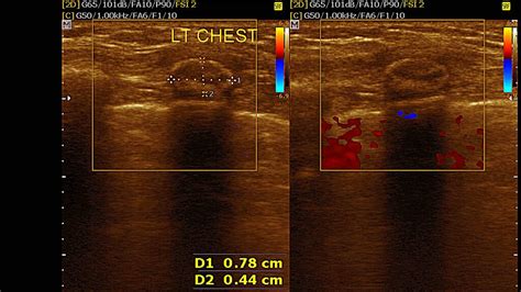 Ultrasound Cases 154 Of 2000 Chest Wall Hypoechoic Mass With Egg Shell Calcification Youtube