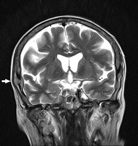 Intracranial Involvement In Multiple Myeloma Presenting As A Cranial