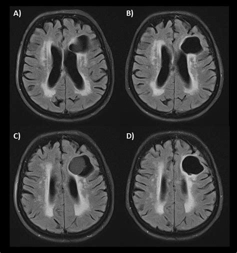 Brain Mri Showing Left Sided Well Defined Mass Flair Sequence A