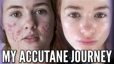 Accutane Before During And After