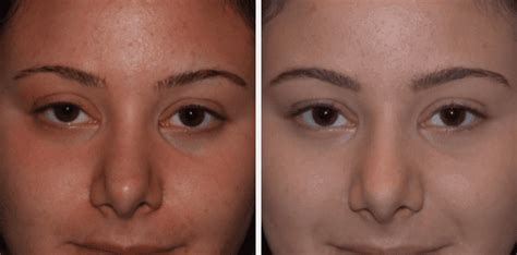 Ptosis Surgery Long Island Droopy Eyelid Treatment Long Island