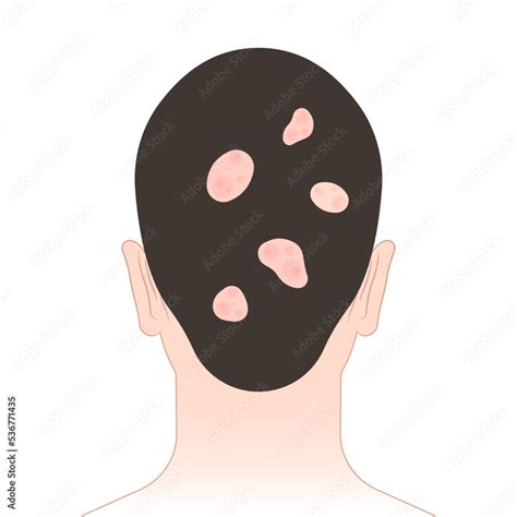 Photo And Art Print Hair Loss Butterfly And Malar Rash Chronic Facial