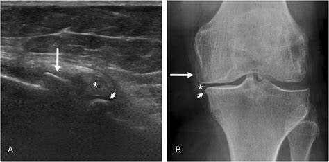 The Ultrasonography Us And Radiography Of The Medial Compartment Of Download Scientific