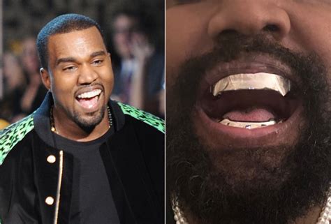 Kanye West não extraiu os dentes para colocar prótese de titânio de R