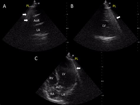 Transthoracic Echocardiogram Demonstrating The Presence Of B Lines