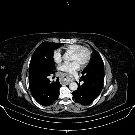 Metastatic Esophageal Cancer Image Radiopaedia Org