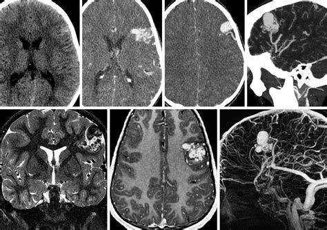 Arteriovenous Malformation The Neurosurgical Atlas