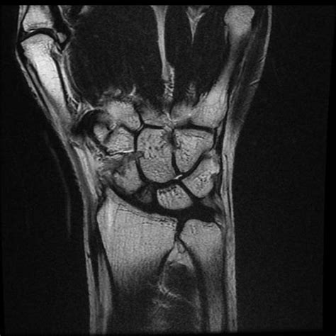 Scaphoid Fracture And Avascular Necrosis Image