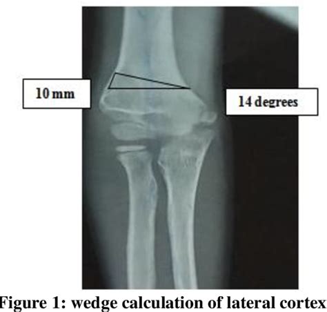 Figure 1 From Fixation Of Supracondylar Osteotomy Of The Humerus For