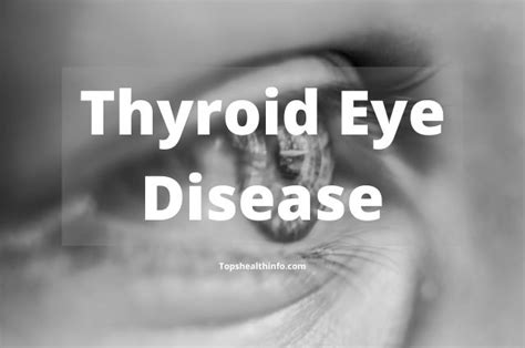 Thyroid Eye Disease What Is Symptoms Causes And Treatments