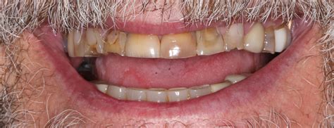 Before And After Holistic Dentistry In Costa Rica Natural Dental Care