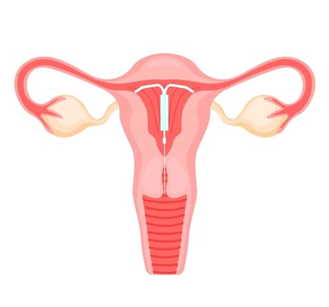 Premium Vector Uterus With Intrauterine Spiral Illustration