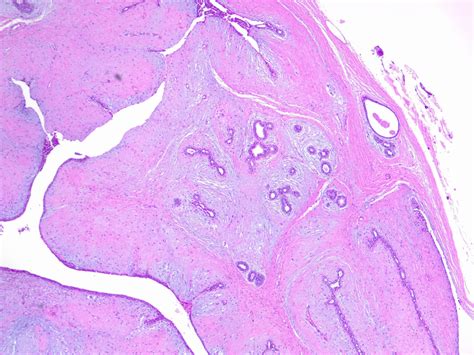 Phyllodes Tumor Of The Breast StatPearls NCBI Bookshelf