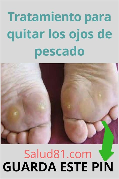 Tratamientos Para Quitar Los Ojos De Pescados Cura Hongos En Las Uñas