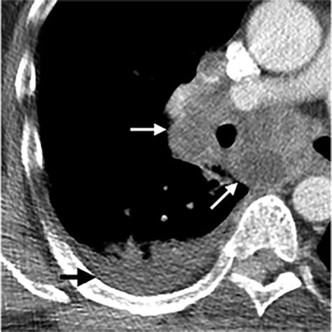 Subcarinal Mediastinal N2 Level And Ipsilateral Hilar N1 Level Download Scientific Diagram