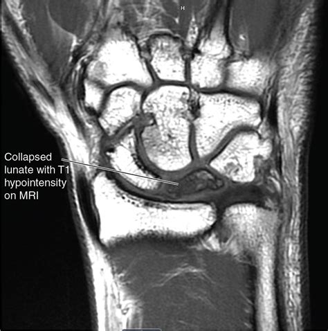 Procedures For Avascular Necrosis Of The Lunate Kienböck Disease