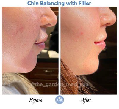 The Garden Medical Spa Dermal Fillers Wrinkle Reduction New