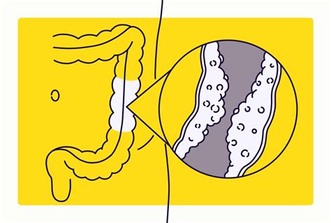 Constrictive And Hypertrophic Strictures In Ileal Crohns Disease New