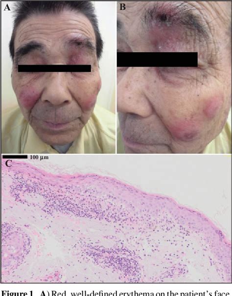 Ts 1 Tegafurgimeraciloteracil Induced Systemic Lupus Erythematosus