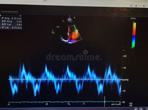 Echocardiogram Colorful Probe Targeting Map And Waveforms Stock Image