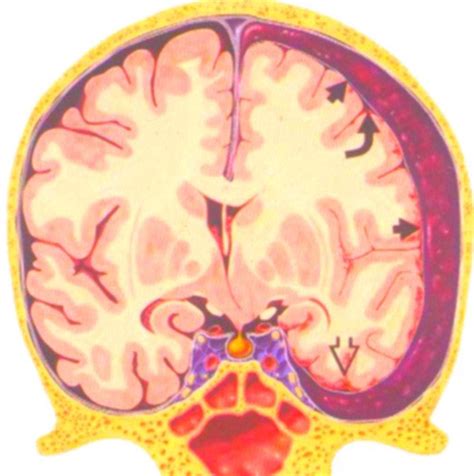 Chronický subdurální hematom | Neurochirurgická klinika