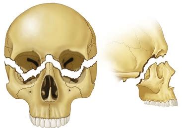 Causes of a le fort fracture - shadowtery