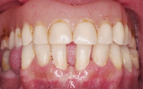 Casos Clínicos Clínica Dental Gallego Odontología Avanzada