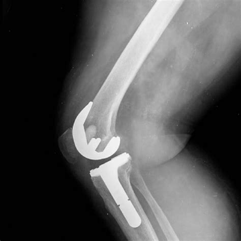 Pdf Popliteal Artery Damage During Total Knee Arthroplasty