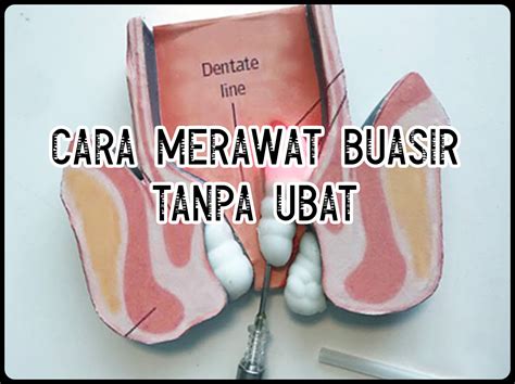 Tips Dan Pengalaman Cara Merawat Buasir Luaran Secara Alami Tanpa Ubat