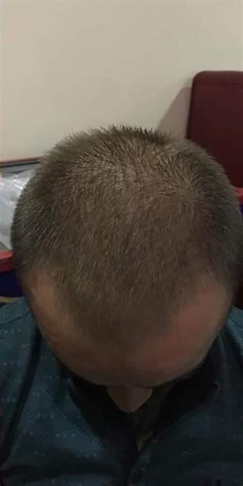 ExtraHair - шампунь и сыворотка для волос ExtraHair®