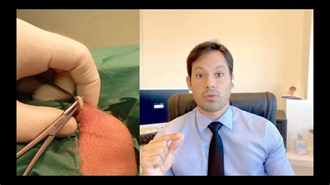 VASECTOMIA Explicando A Cirurgia YouTube