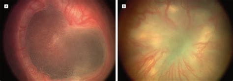 The International Classification Of Retinopathy Of Prematurity