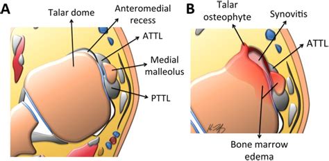 Ankle Impingement Syndromes An Imaging Review Pmc