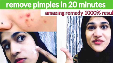 How To Make Remove Pimples In 20minutes Get Rid Remove Pimples Fast Remove Pimples Overnight