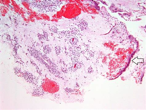 Left Histopathological Examination Of The Mass In Low Power