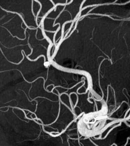 Endovascular Treatment Of A Ruptured Aneurysm At A Very Rare Location