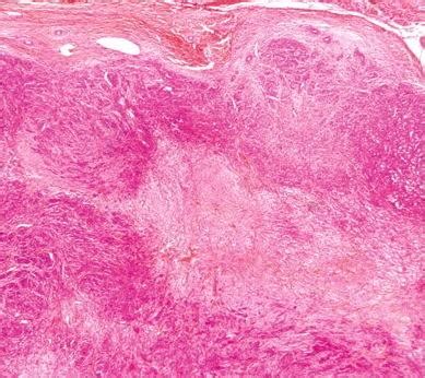 Epithelioid Sarcoma - Pathology - Orthobullets