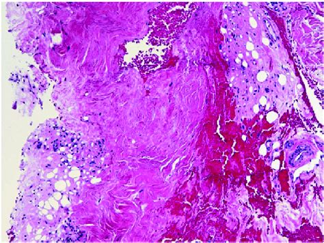 Dermal Scarring And Associated Subcutaneous Lipoatrophy Skin Punch