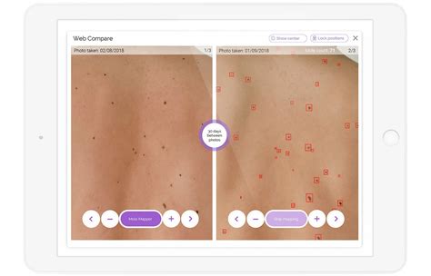 What Is Mole Mapping And Why Is It Important For Your Health Skin Sexiz Pix