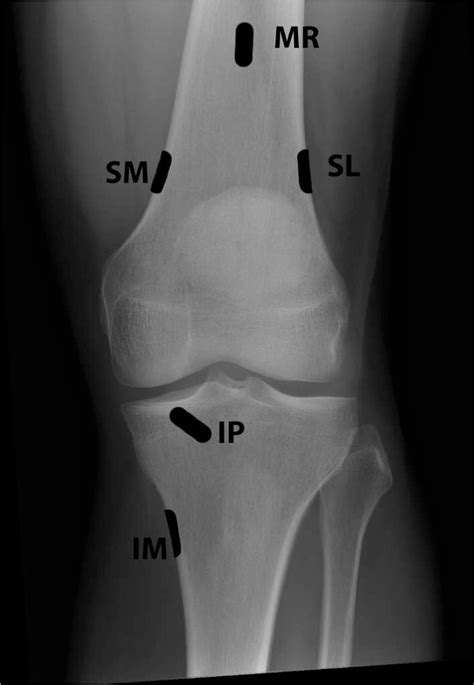 Fluoroscopic Guided Knee Genicular Nerve Radiofrequency Ablation The