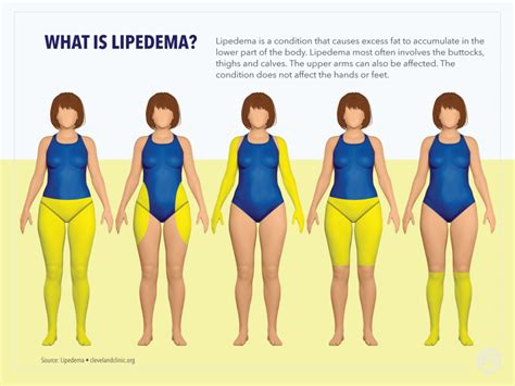 Lipedema AIROS Medical Inc