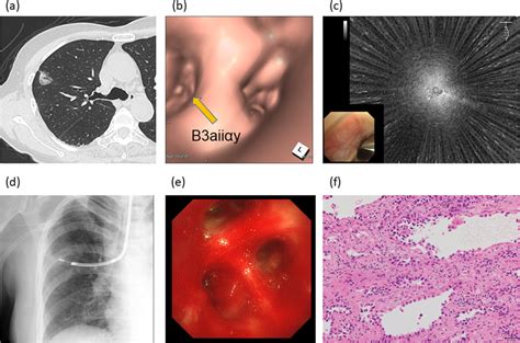 Representative Case Of Transbronchial Cryobiopsy Using The Two Scope Download Scientific