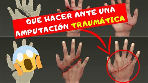 Que Hacer Ante Una Amputación Traumática Cuidados Para Un Reimplante