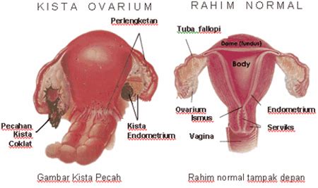 Ciri Ciri Kista Pada Rahim Sinau